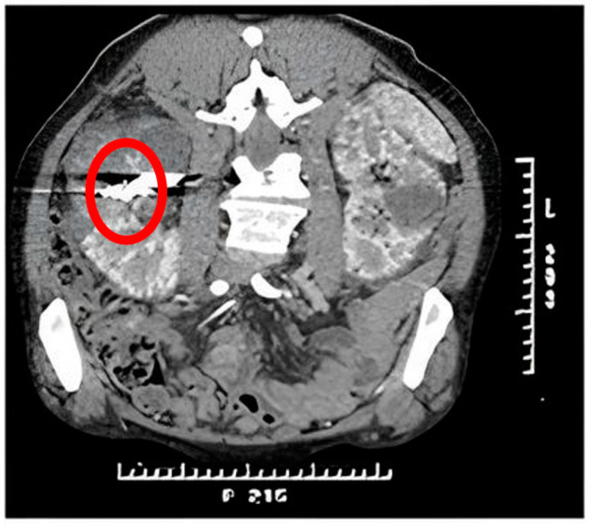 AVM dAVF Endovascular Embolization — Figure A4