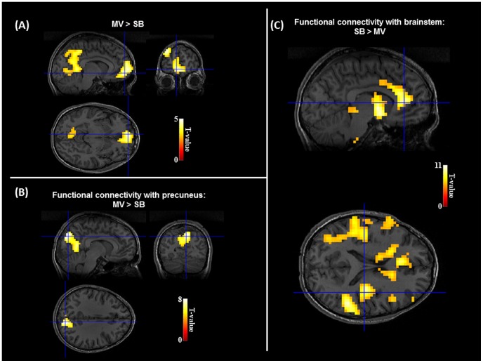 Awake Craniotomy Cortical Subcortical Mapping — Figure 2