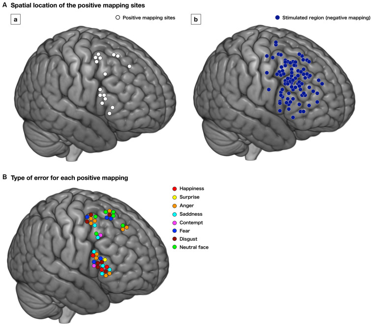 Awake Craniotomy Cortical Subcortical Mapping — Figure 3