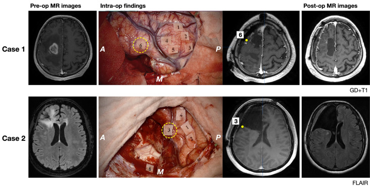 Awake Craniotomy Cortical Subcortical Mapping — Figure 6