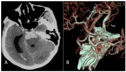 Basilar Apex Aneurysm — Figure 1