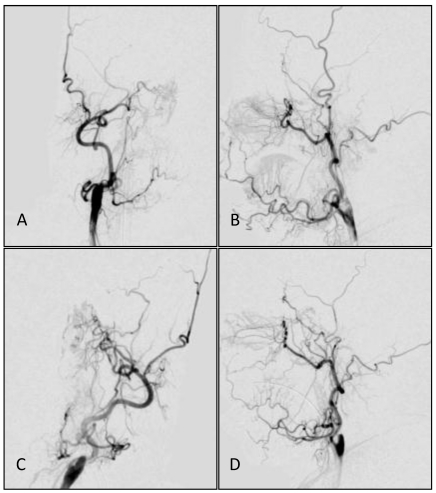 Basilar Apex Aneurysm — Figure 2