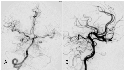 Basilar Apex Aneurysm — Figure 3