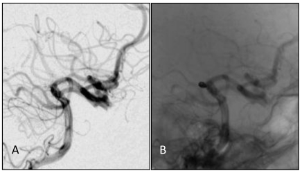 Basilar Apex Aneurysm — Figure 4