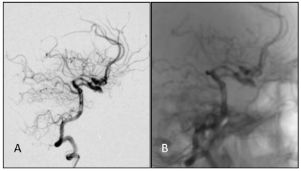 Basilar Apex Aneurysm — Figure 5
