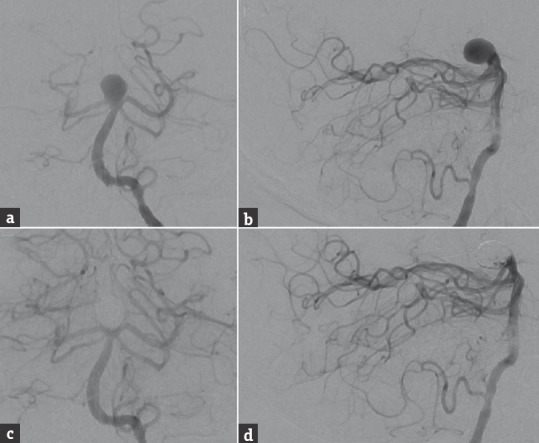 Basilar Apex Aneurysm — Figure 1