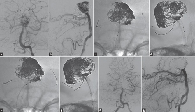 Basilar Apex Aneurysm — Figure 2