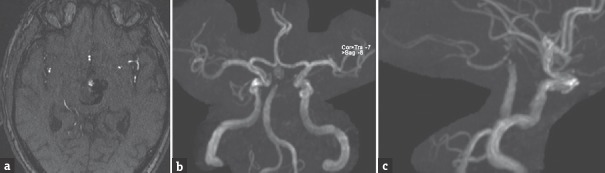 Basilar Apex Aneurysm — Figure 3