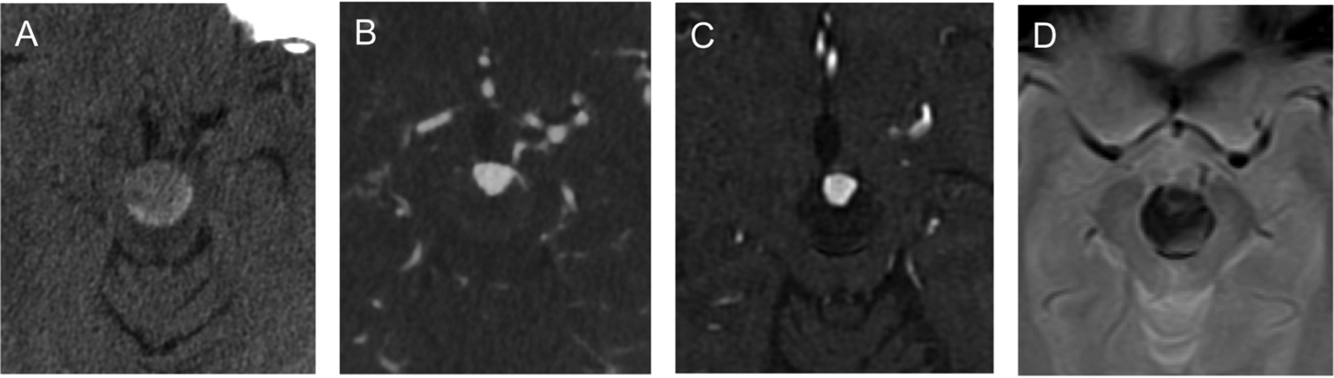 Basilar Apex Aneurysm — Fig. 1.