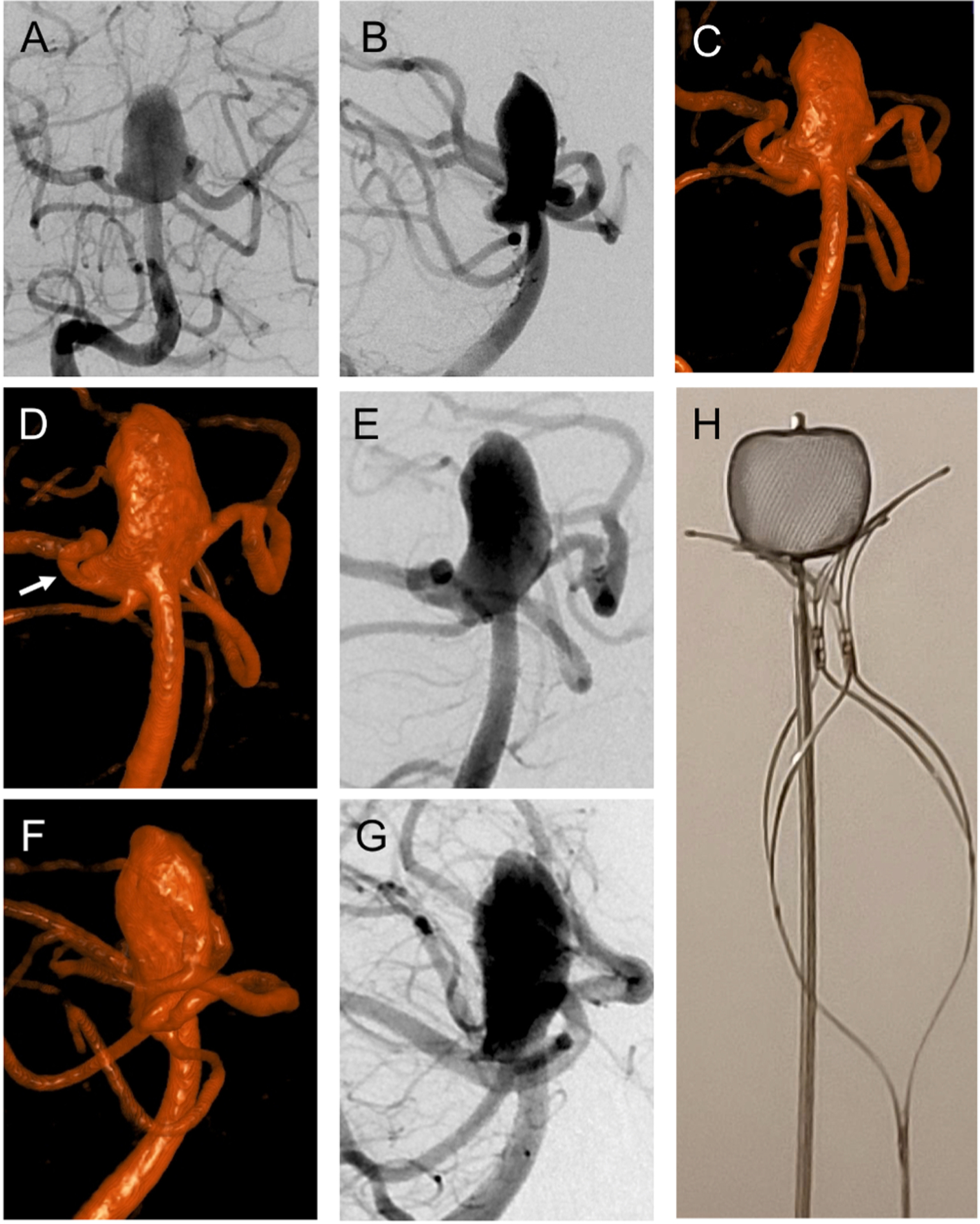 Basilar Apex Aneurysm — Fig. 2.