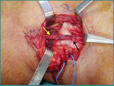 Brachial Plexus Injury Exploration, Repair, Grafting, Nerve Transfer — Figure 2