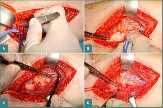 Brachial Plexus Injury Exploration, Repair, Grafting, Nerve Transfer — Figure 3