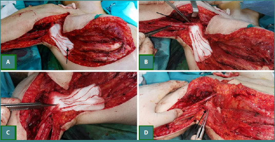 Brachial Plexus Injury Exploration, Repair, Grafting, Nerve Transfer — Figure 4