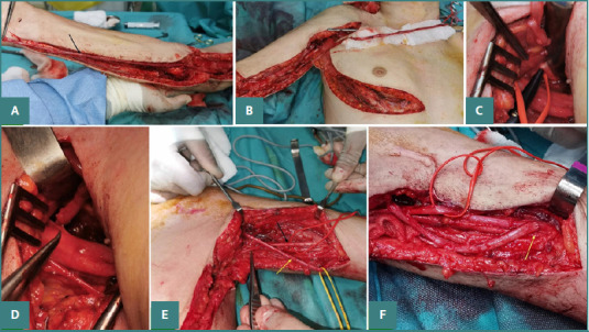 Brachial Plexus Injury Exploration, Repair, Grafting, Nerve Transfer — Figure 5