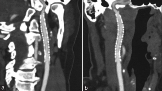 Carotid Artery Angioplasty Stenting — Figure 2