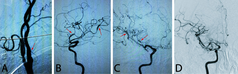 Carotid Artery Angioplasty Stenting — Figure 2