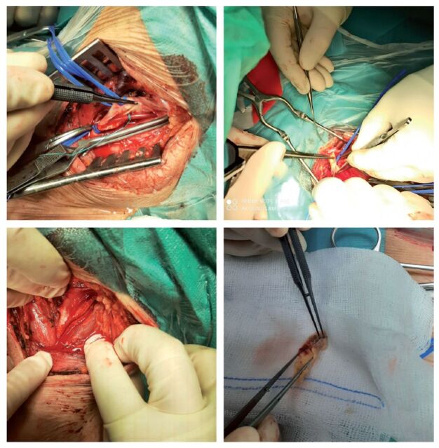 Carotid Endarterectomy — Figure 2