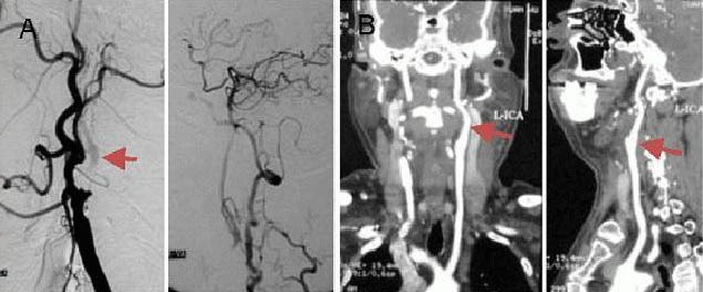 Carotid Endarterectomy — Figure 1