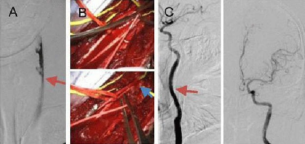 Carotid Endarterectomy — Figure 2