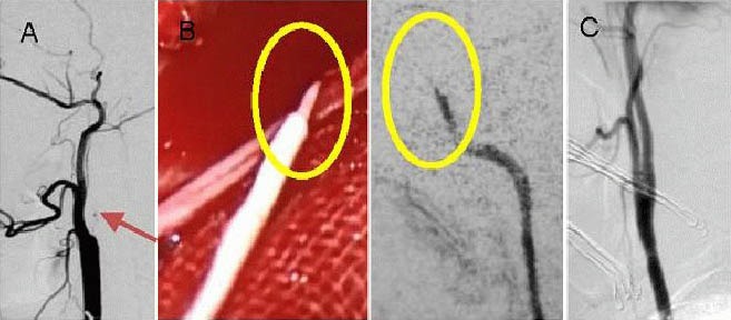 Carotid Endarterectomy — Figure 3