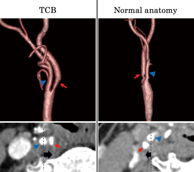 Carotid Endarterectomy — Fig. 1