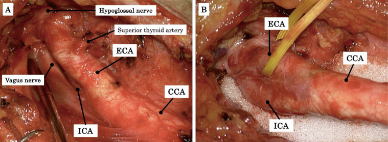 Carotid Endarterectomy — Fig. 2
