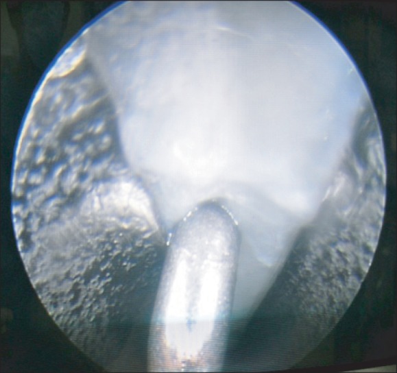 Carpal Tunnel Release — Fig. 2