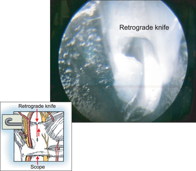 Carpal Tunnel Release — Fig. 4