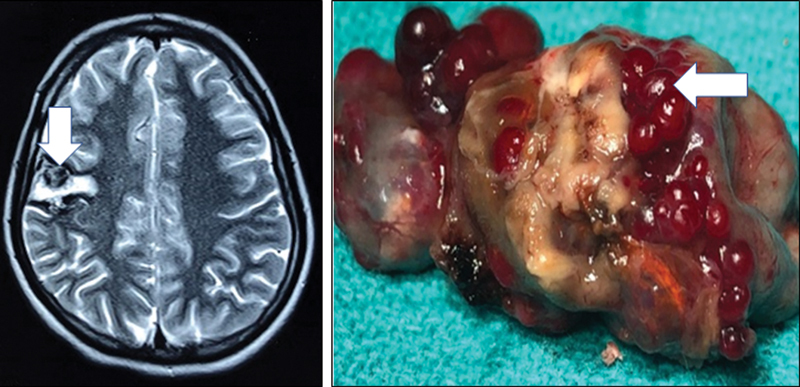 Cavernous Malformation Resection — Fig. 1