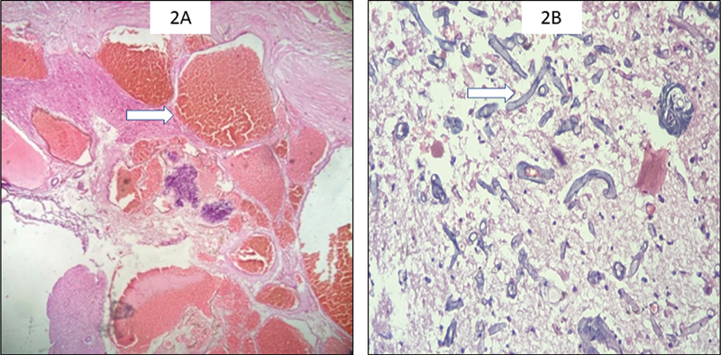 Cavernous Malformation Resection — Fig. 2