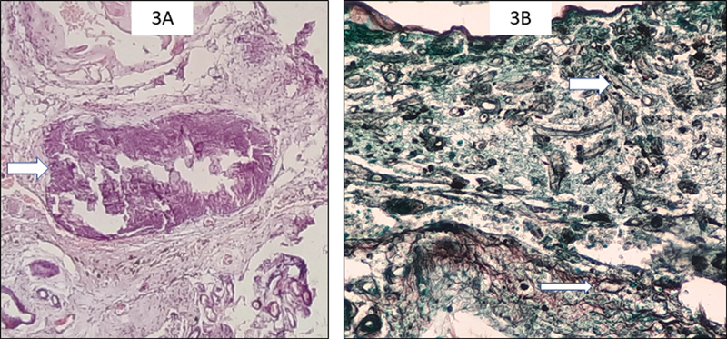 Cavernous Malformation Resection — Fig. 3