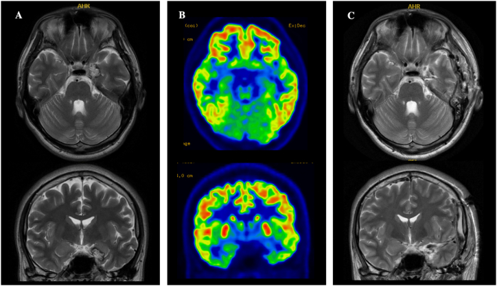 Cavernous Malformation Resection — Fig. 1