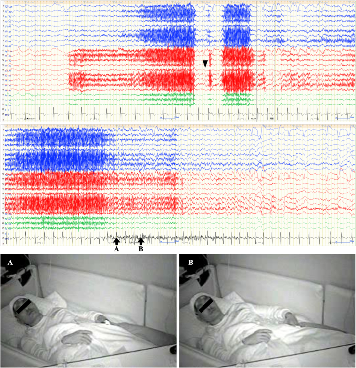 Cavernous Malformation Resection — Fig. 2
