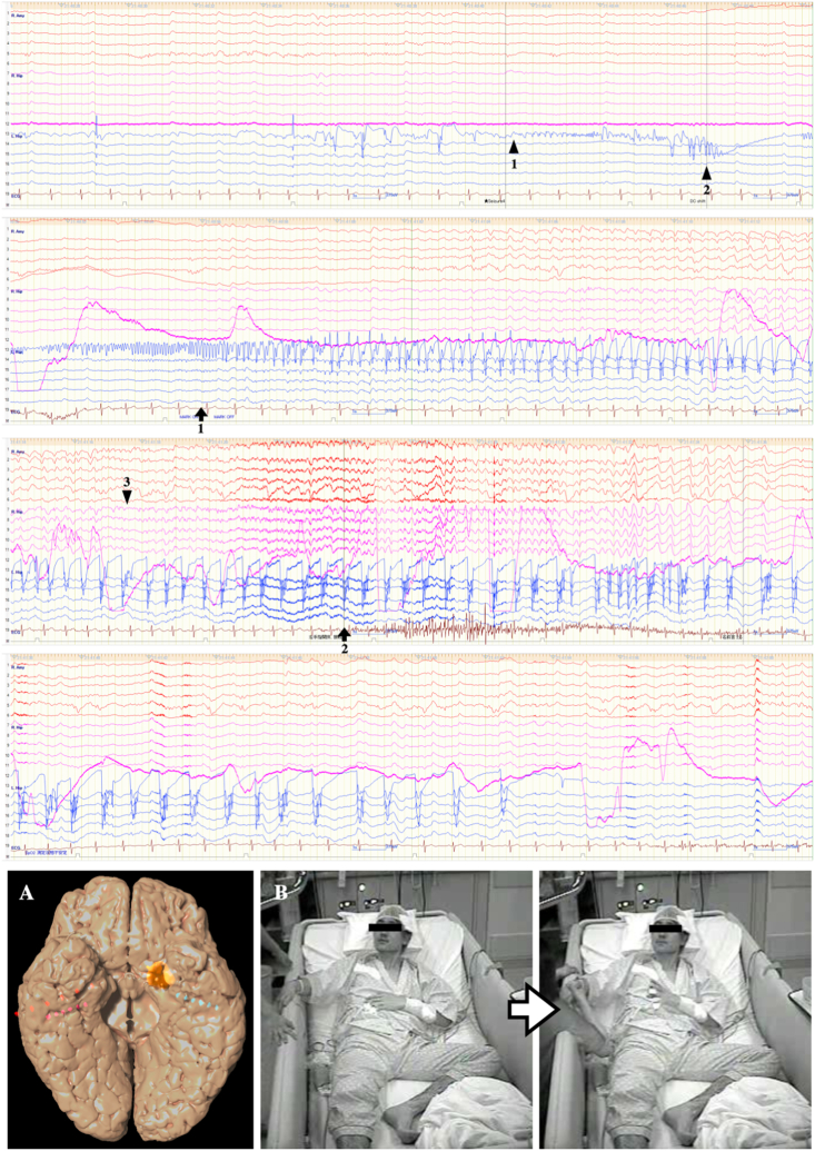 Cavernous Malformation Resection — Fig. 3