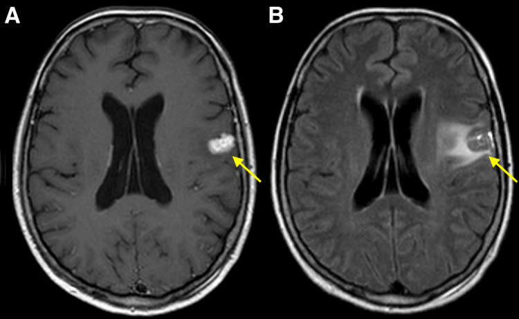 Cavernous Malformation Resection — Figure 1