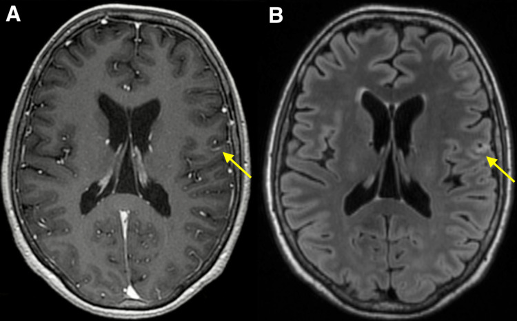 Cavernous Malformation Resection — Figure 2
