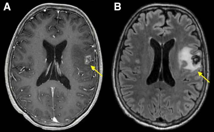 Cavernous Malformation Resection — Figure 3