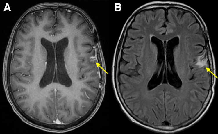 Cavernous Malformation Resection — Figure 4