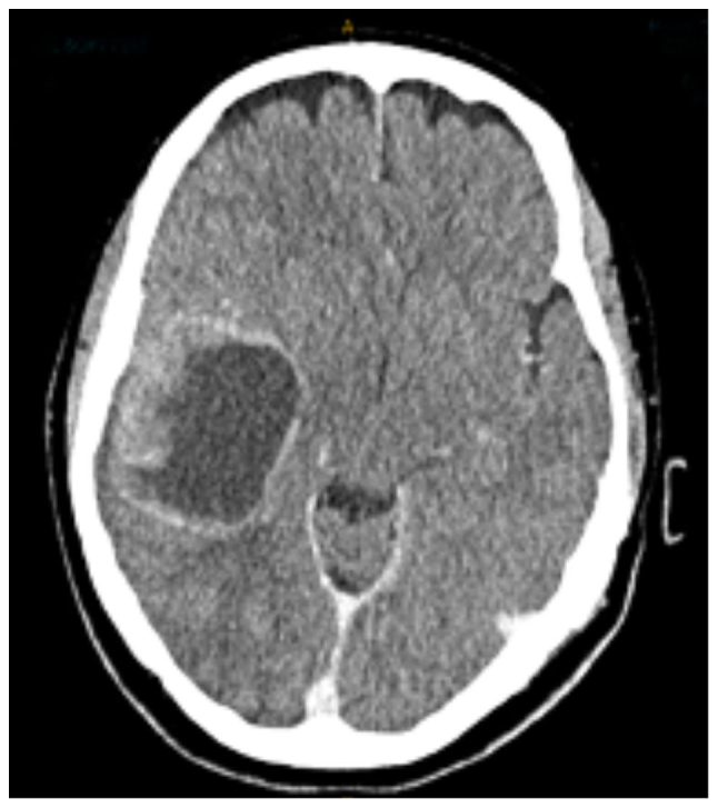 Cerebral Metastasis Resection — Figure 1.