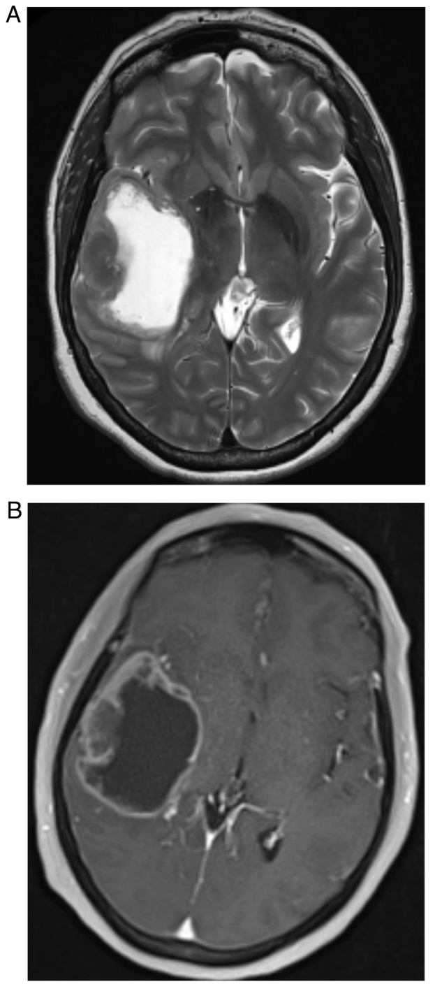 Cerebral Metastasis Resection — Figure 2.