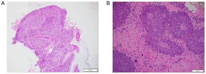 Cerebral Metastasis Resection — Figure 3.