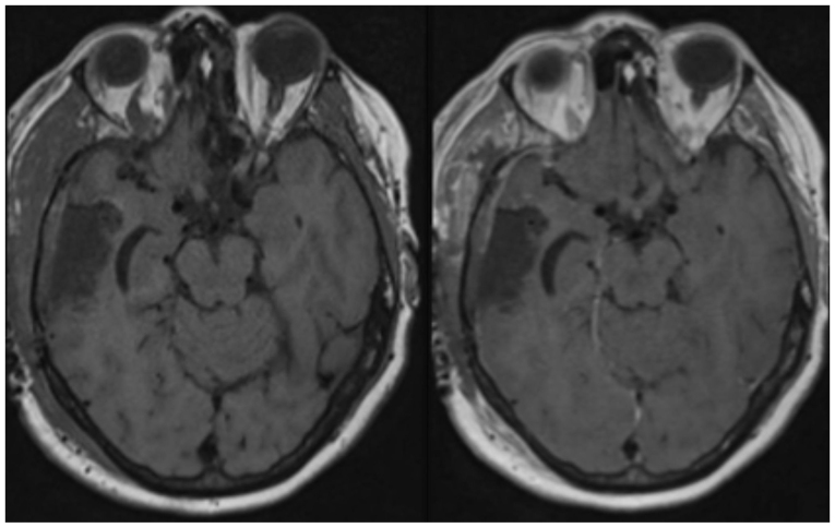 Cerebral Metastasis Resection — Figure 4.