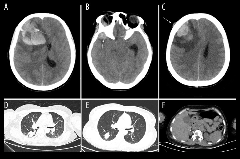 Cerebral Metastasis Resection — Figure 1.