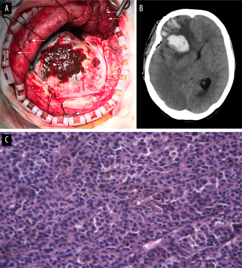 Cerebral Metastasis Resection — Figure 2.