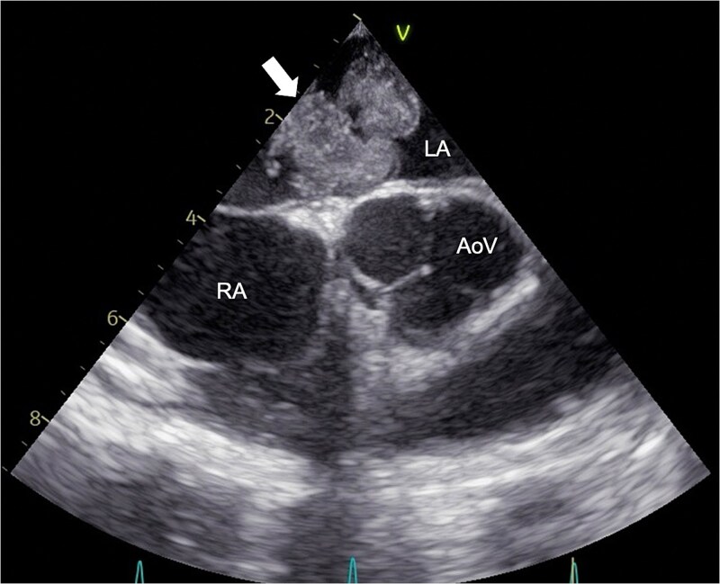 Cerebral Metastasis Resection — Figure 1