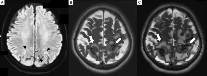 Cerebral Metastasis Resection — Figure 2