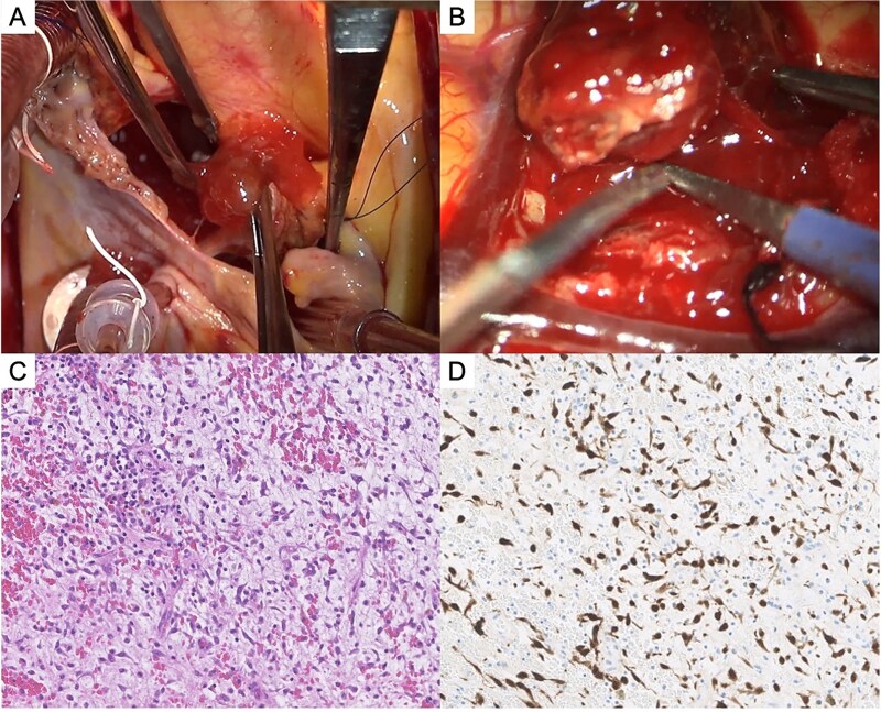 Cerebral Metastasis Resection — Figure 3