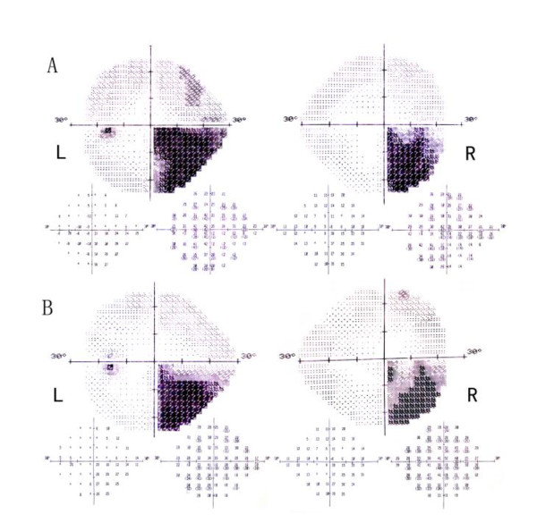Cerebral Metastasis Resection — Figure 1