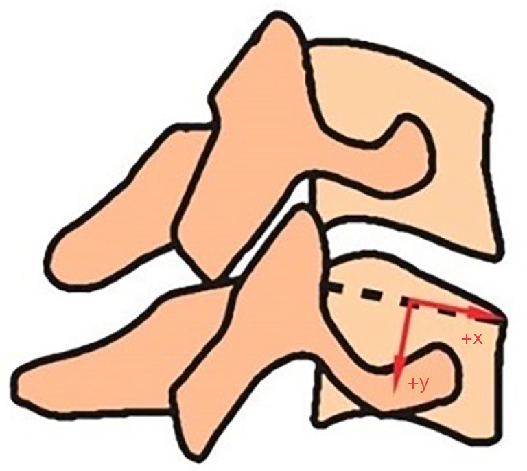 Cervical Disc Arthroplasty — Figure 1