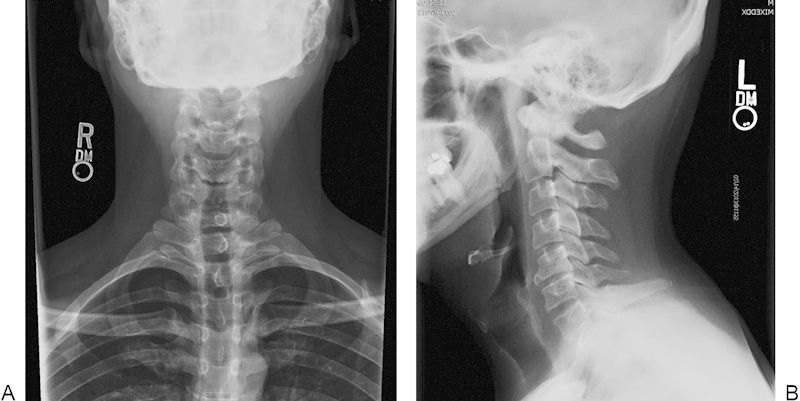 Cervical Disc Arthroplasty — Fig. 1